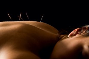 woman during acupuncture treatment